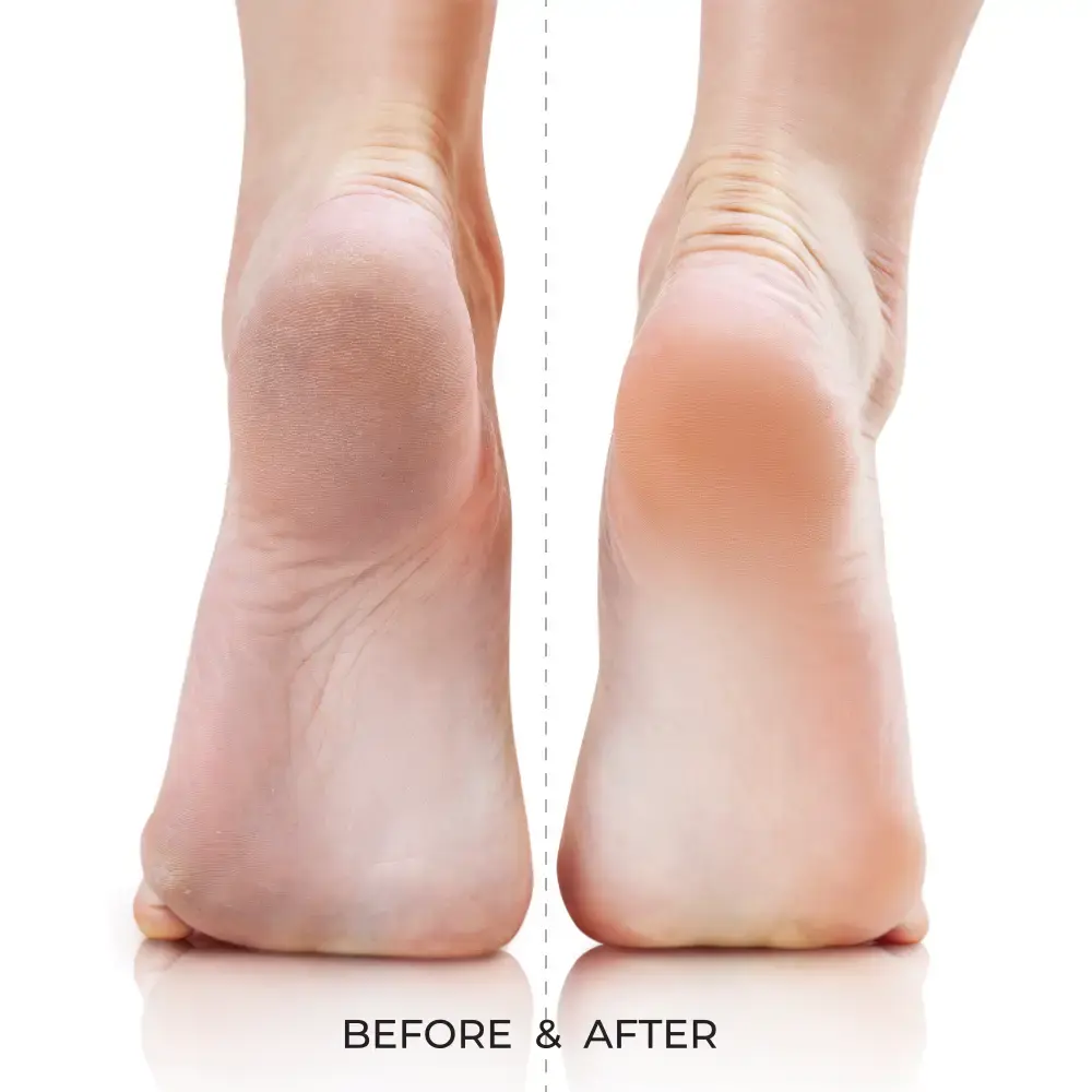 Kiss New York Dual-Sided Foot File for Callus Removal and Smooth, Soft Feet - Image 13