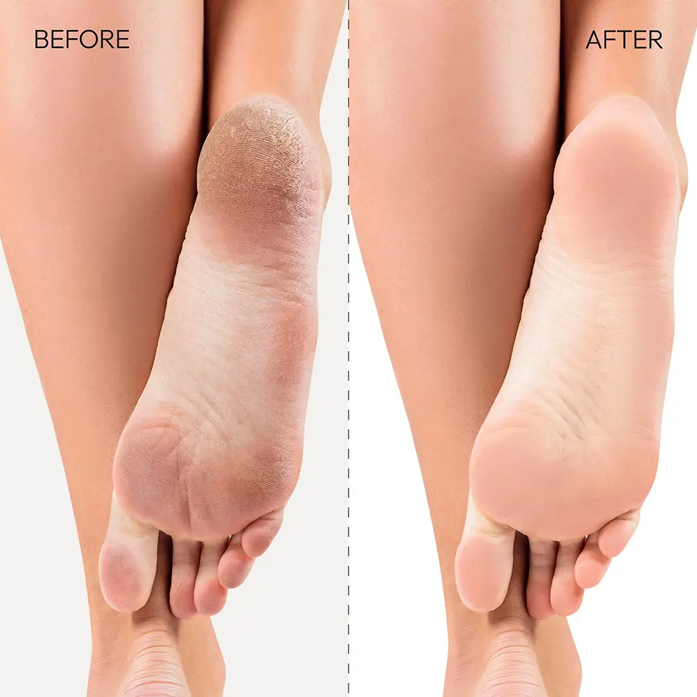 Kiss New York Dual-Sided Foot File for Callus Removal and Smooth, Soft Feet - Image 5